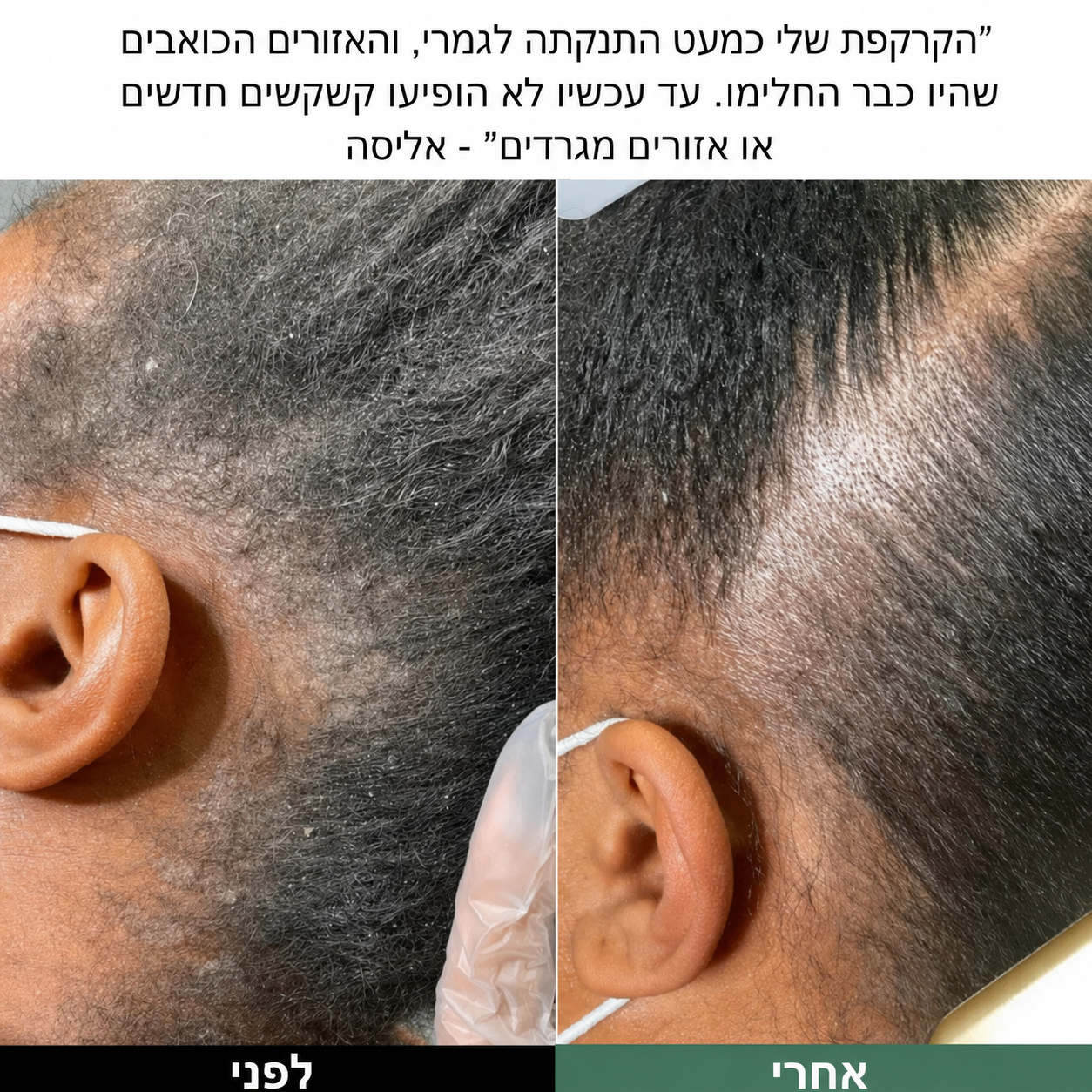 Lissima – פילינג טבעי לקרקפת